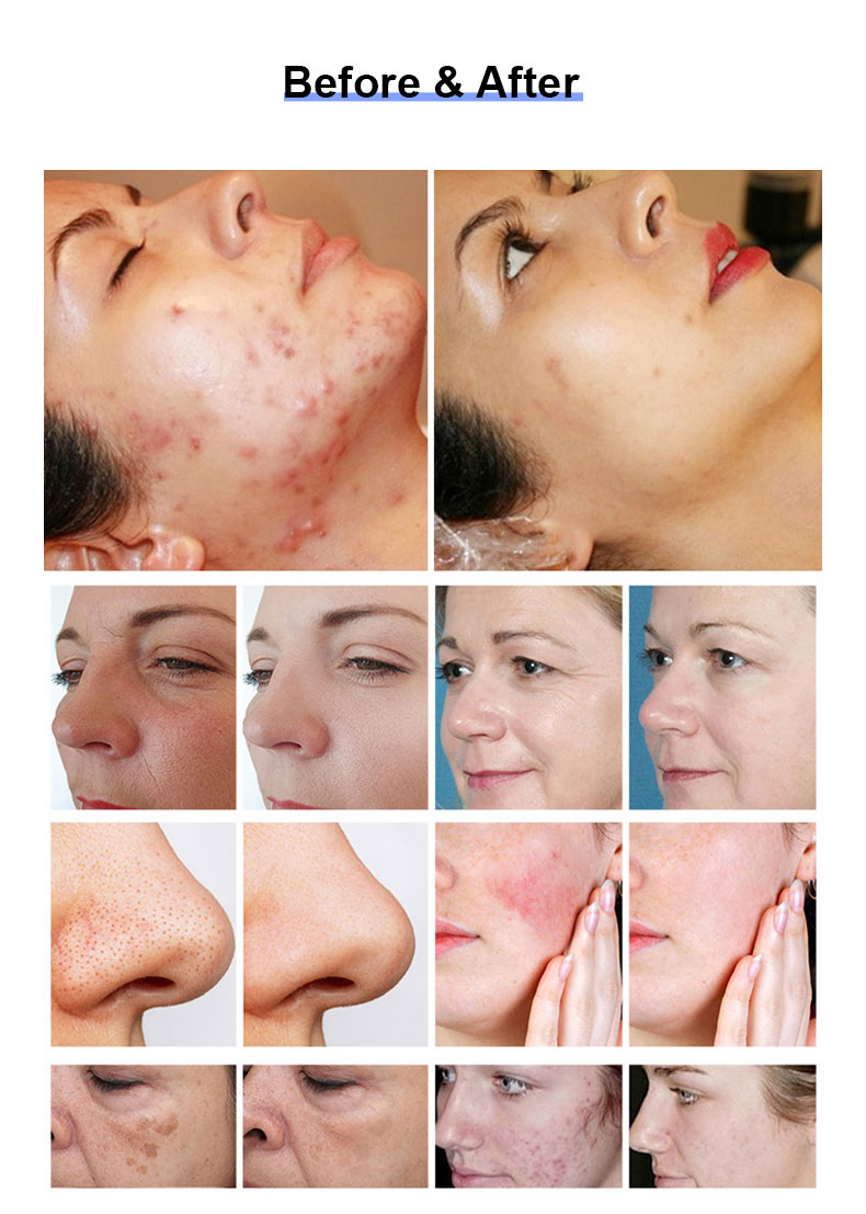 Thulium Laser