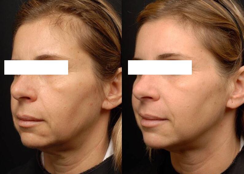 B&A 3