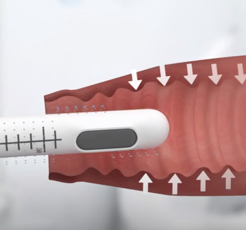 Regarding HIFU vaginal treatments