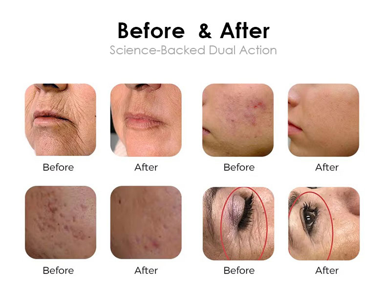 Skin Rejuvenation