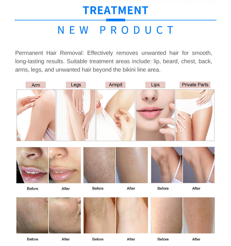 laser hair removal equipment