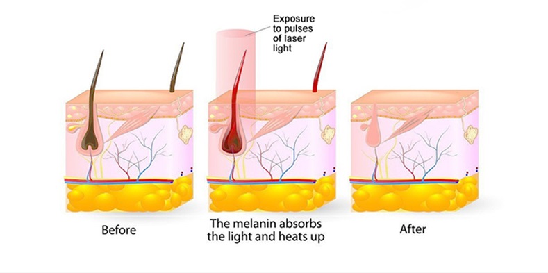 hair removal machine