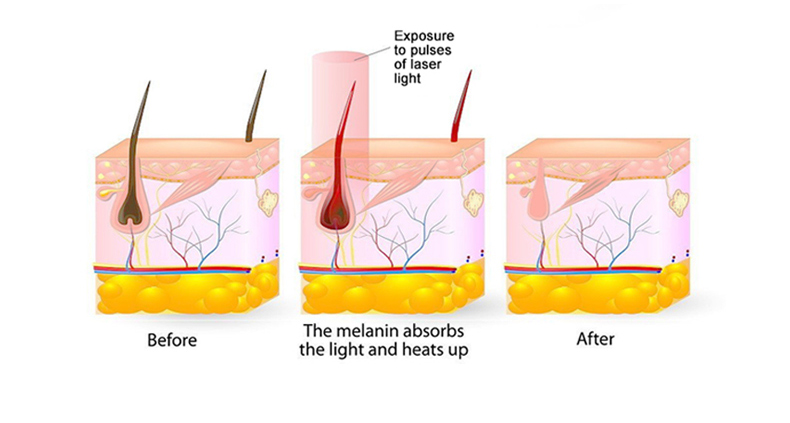 hair removal machine