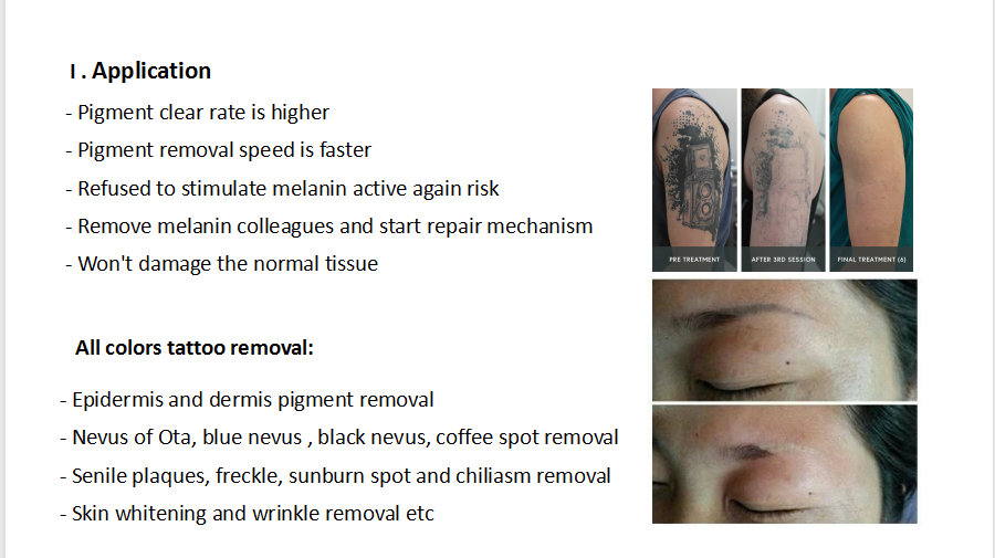 picosecond laser