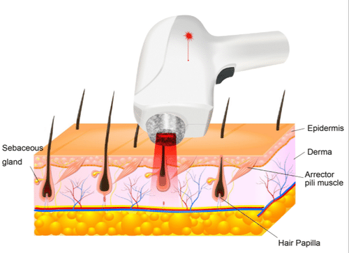 Body depilation machine
