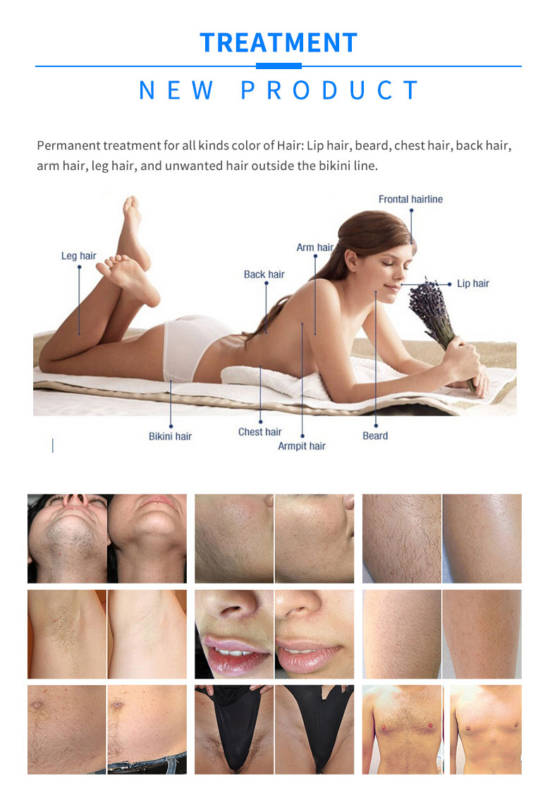 laser hair removal machine