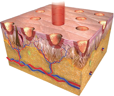 Fractional CO2 Laser