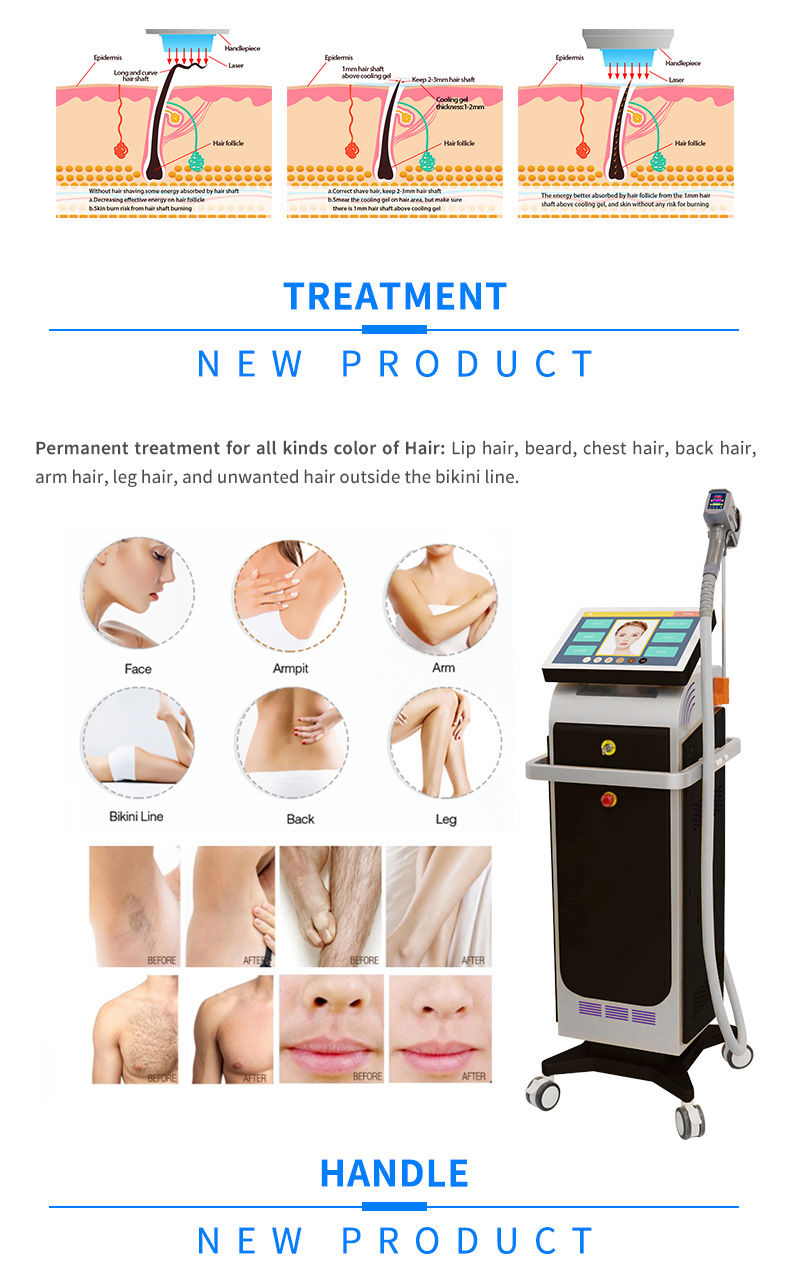 laser hair removal 
