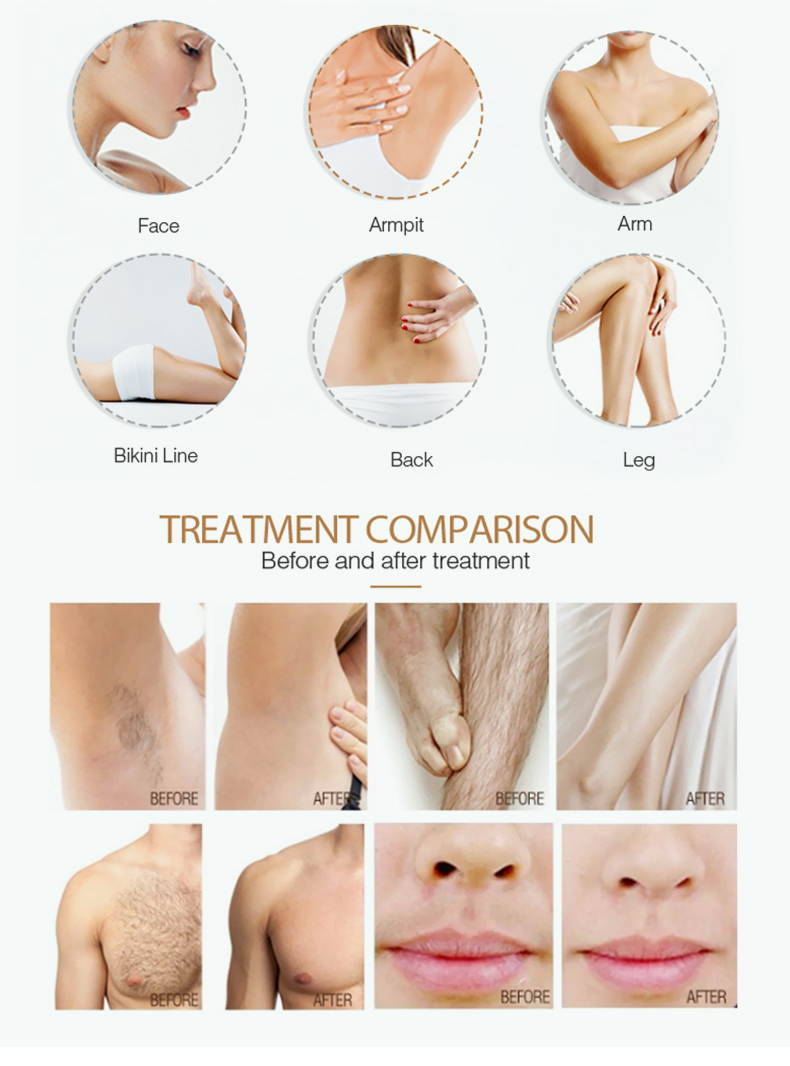 hair removal machine