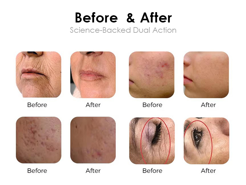 Wrinkle Removal Machine