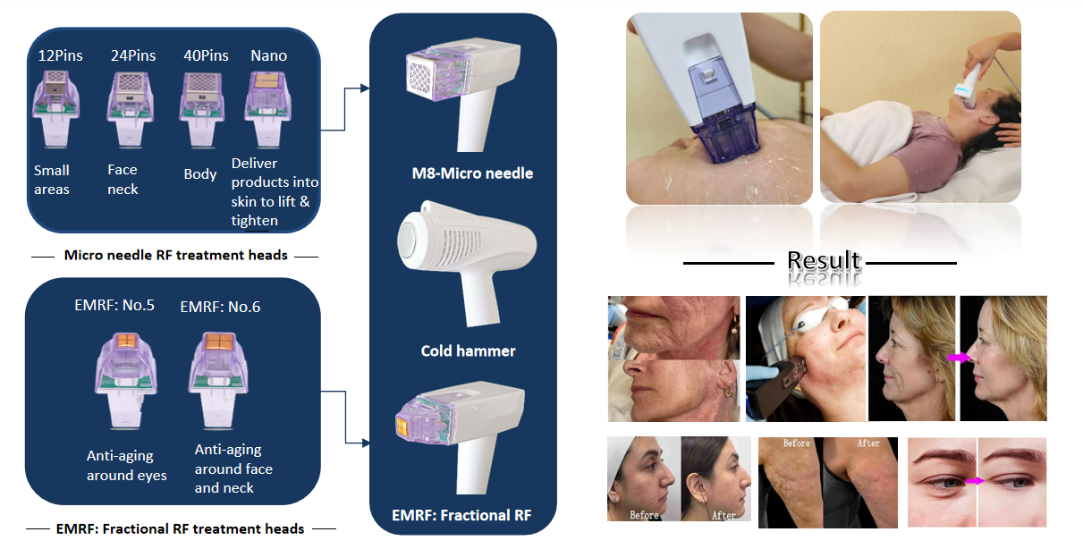 Micro Needle Hifu