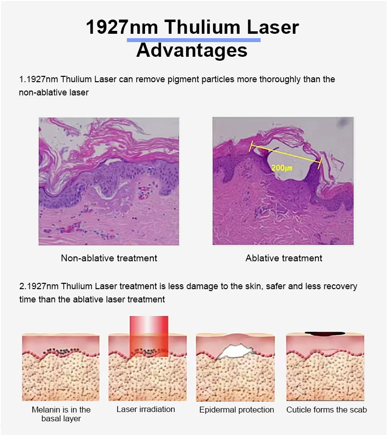 Thulium Laser