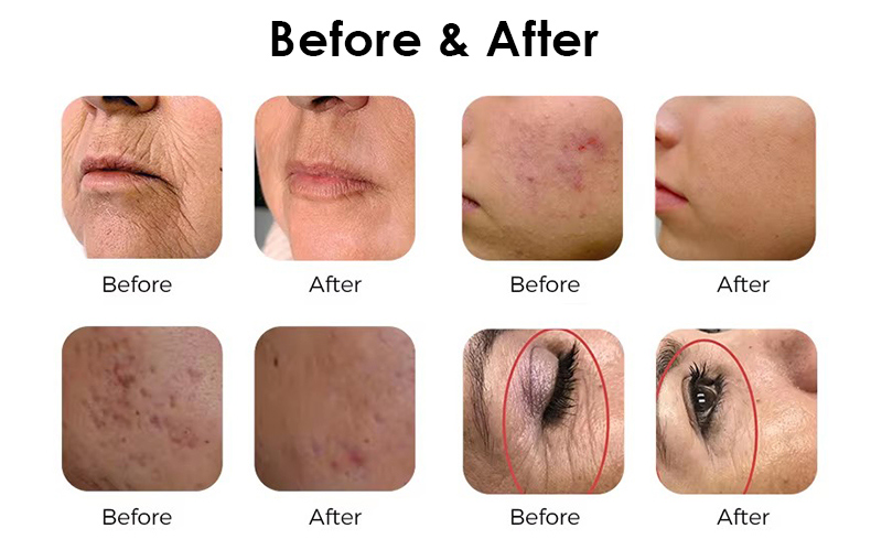Thulium Laser
